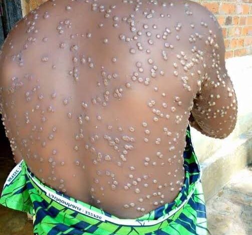 Sud-Kivu : La riposte contre le MPOX s'intensifie, la réduction des cas malgré une situation préoccupante