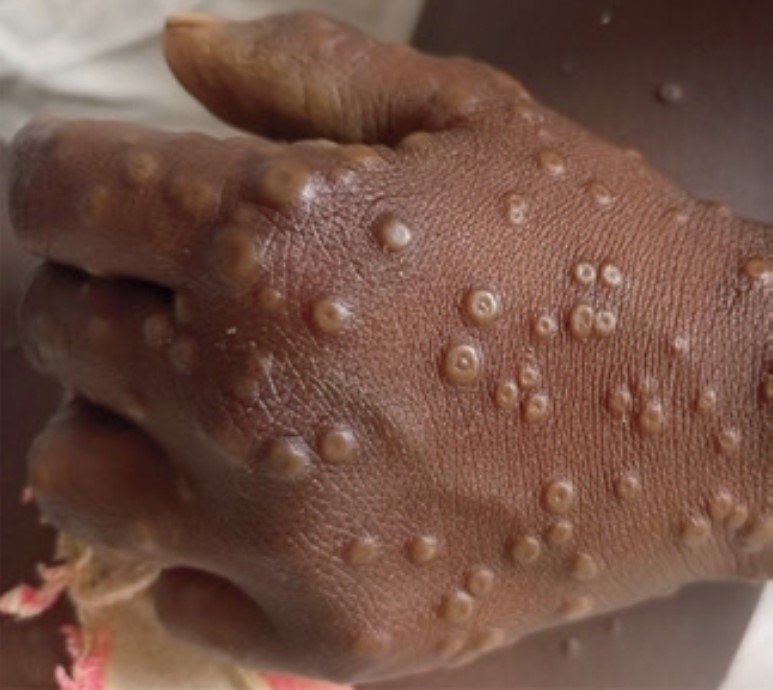 Sud-Kivu : Alerte MPOX à Kaziba, des milliers de vies en danger