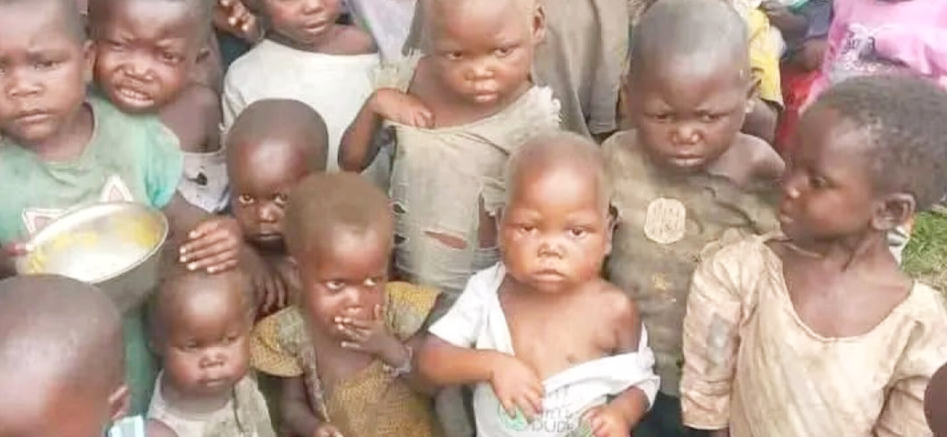 Sud-Kivu : la malnutrition infantile s'aggrave dans les zones en conflits