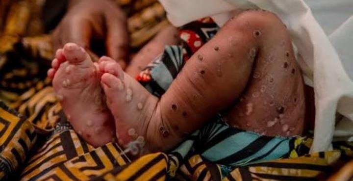 Sud-Kivu : Des enfants déplacés victimes de l'épidémie de rougeole à Kelehe et Walungu