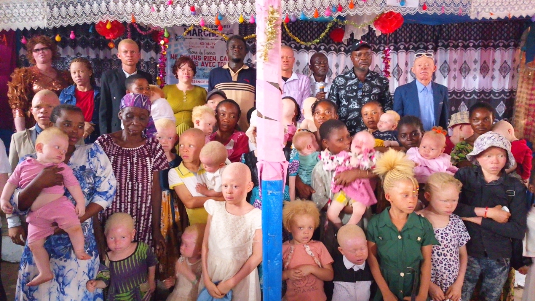 Journée internationale de sensibilisation à l’albinisme : l’AOV mobilise à Kananga pour l’inclusion et la défense des droits des personnes albinos